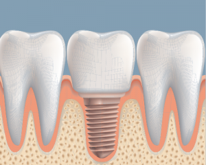 Implant Success