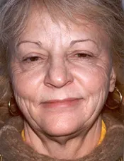 Patient's face before a eyelid surgery case 1