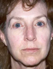 Patient's face before a face lift case 1
