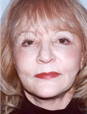 Patient's face after eyelid surgery case 1