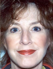 Patient's face after a face lift case 1
