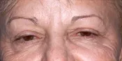 Case 1 closer image of Patient's face before a eyelid surgery