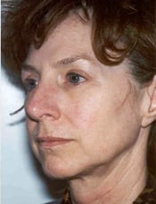 Patient's face before a face lift case 2