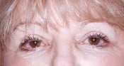 Case 1 closer image of Patient's face after eyelid surgery