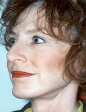 Patient's face after a face lift case 2