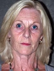 Patient's face before a face lift case 3