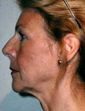 Side view of patient's face before a face lift case 4
