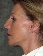 Side view of patient's face after a face lift case 4