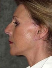 Side view of patient's face after a face lift case 4
