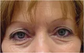 Patient's face before eyelid surgery case 6