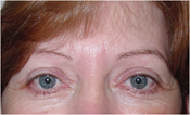 Patient's face after eyelid surgery case 6