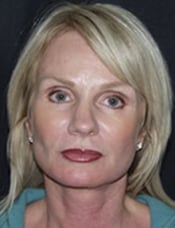 Patient's face after a face lift case 5