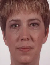 Patient's face before a eyelid surgery case 3