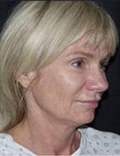 Patient's face before a face lift case 5