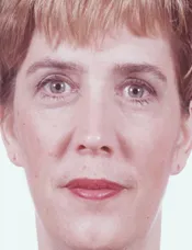 Patient's face after eyelid surgery case 3
