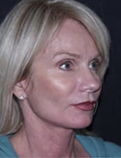 Patient's face after a face lift case 5