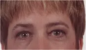 Patient's face before a eyelid surgery case 3 closer image