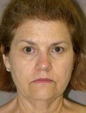 Patient's face before a face lift case 6