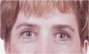 Patient's face after eyelid surgery case 3 closer image