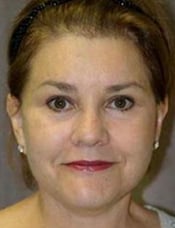 Patient's face after a face lift case 6