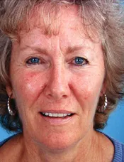 Patient's face before eyelid surgery 4