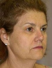 Patient's face before a face lift case 6