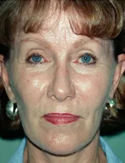 Patient's face after eyelid surgery case 4