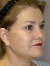 Patient's face after a face lift case 6