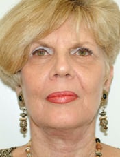 Patient's face after a face lift case 7