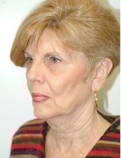 Patient's face before a face lift case 7