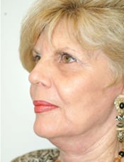 Patient's face after a face lift case 7