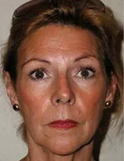 Patient's face before a face lift case 8