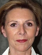 Patient's face after a face lift  case 8