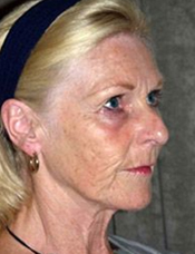 Patient's face before a face lift case 9
