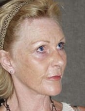 Patient's face after a face lift case 9