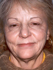 Patient's face before a face lift case 10