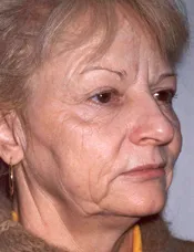 Patient's face before a face lift case 10