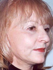 Patient's face after a face lift case 10