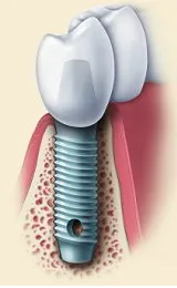 An image illustrating what a dental implant looks like after oral surgery with root and restoration attached