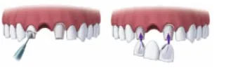 Illustration of a dental bridge attached to front teeth