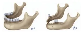 An illustration of a jaw bone before and after implants have been placed