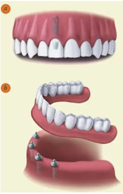 An illustration of a denture attached to the lower jaw by dental implants