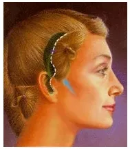 Illustration of a woman's profile showing the typical hairline incision made for a face lift