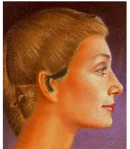 Illustration of a woman's profile showing an alternative incision, short scar incision, for a face lift