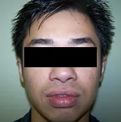 Patient's face after otoplasty