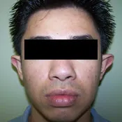 Patient's face before otoplasty