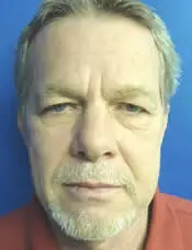Patient's face before a eyelid surgery case 2