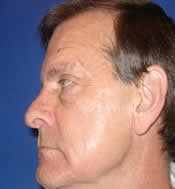 Side view of patient's face after eyelid surgery case 5