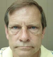 Patient's face before eyelid surgery case 5