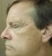 Side view of patient's face before eyelid surgery case 5
